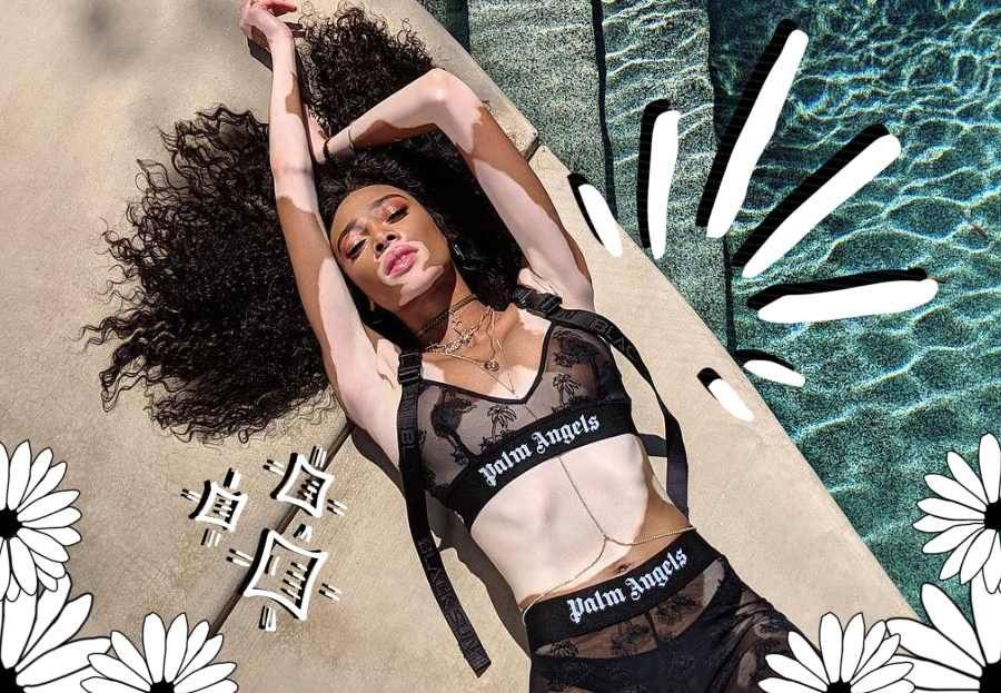 vitiligo
