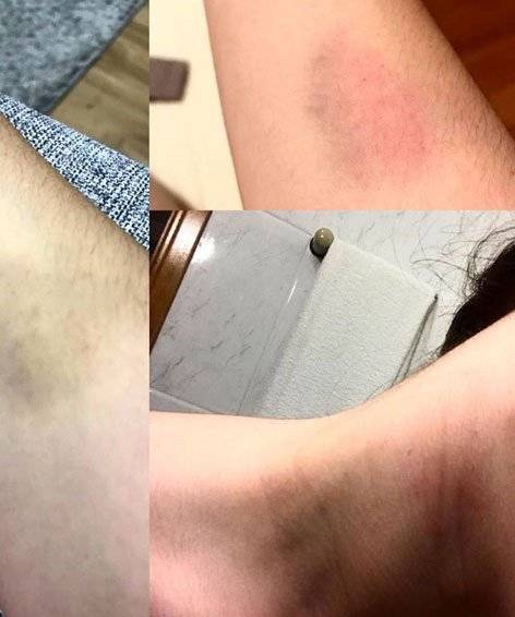 hematomas Jeniffer de Oliveira