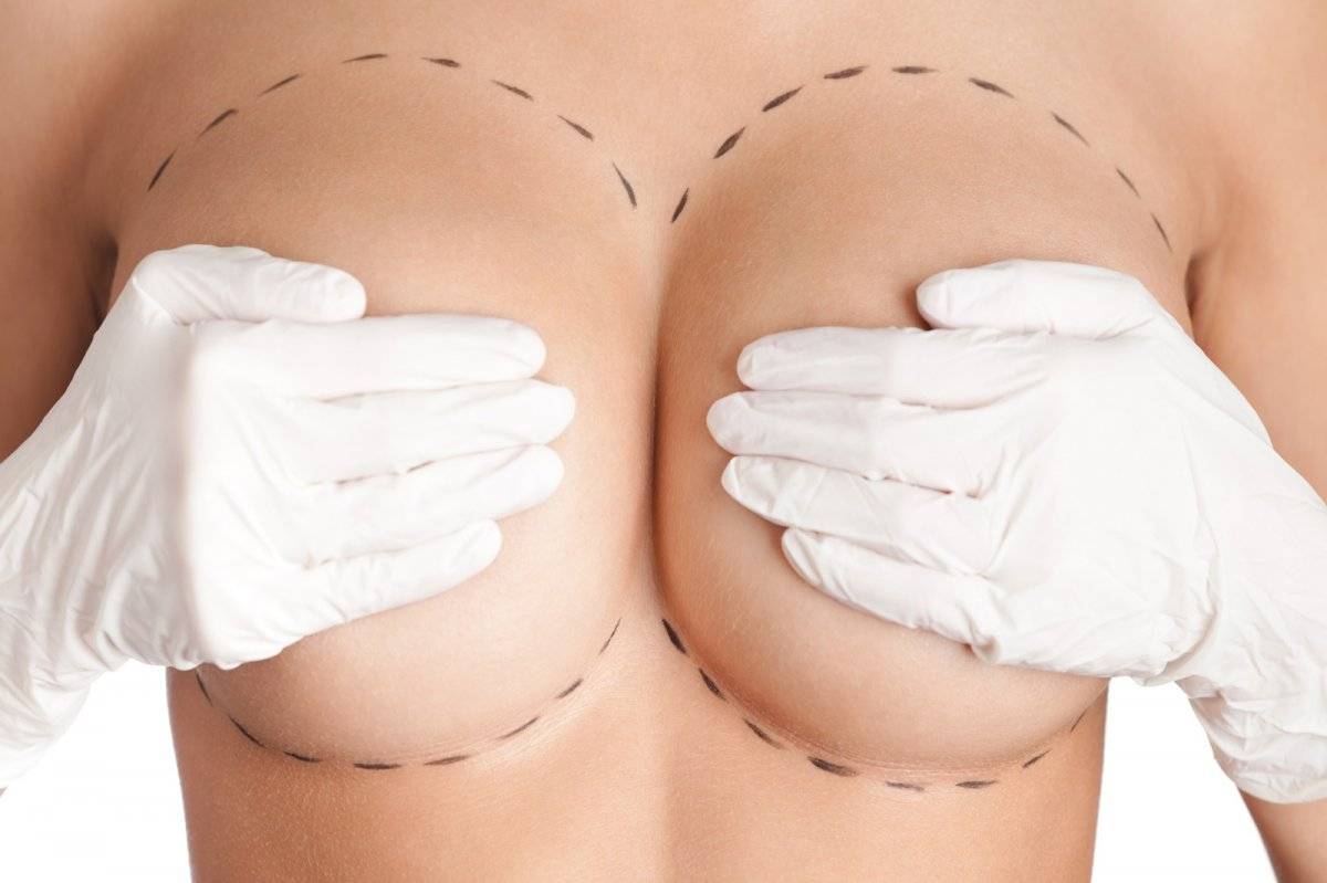 Implantes