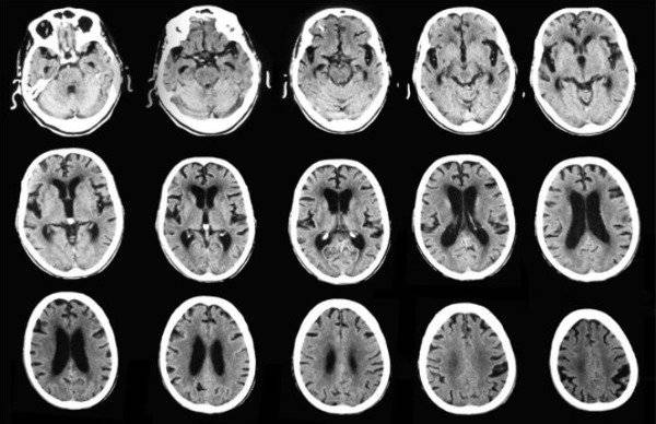 Extraen huevos de parásitos del cerebro de una niña