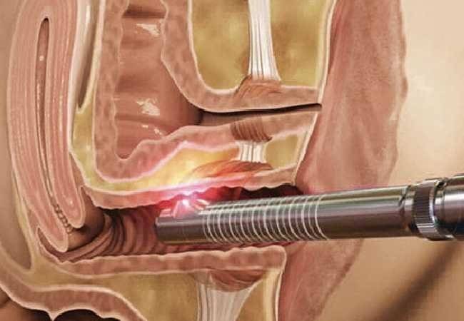 rejuvenecimiento vaginal