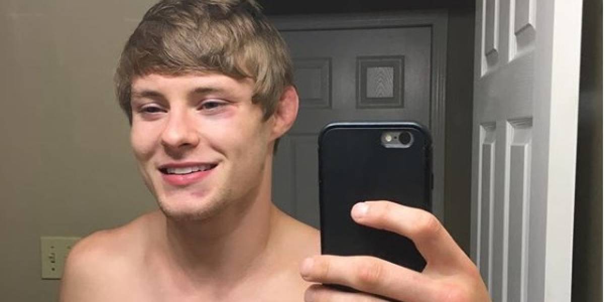 Escalofriante lesión de un peleador de UFC en un accidente doméstico