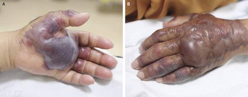 amputar la mano
