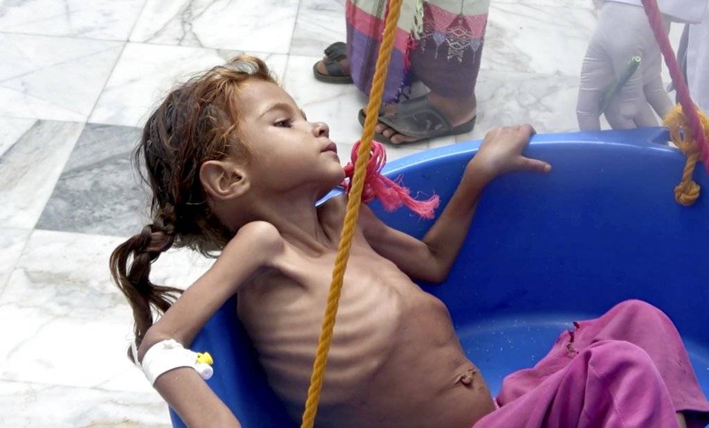 hambruna en Yemen AP