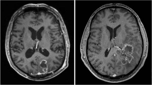 El virus del Zika podría ser útil para combatir este terrible tipo de cáncer
