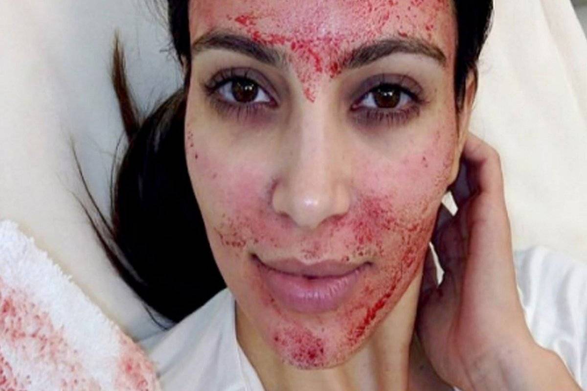 Kim Kardashian Facial Vampiro