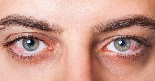 ojos-rojos