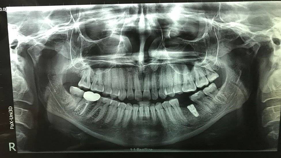 103797000teeth976-f113732bc7cfbbcb27f09c0c60cb71cb.jpg