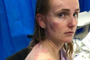 'Mal consegui pensar na dor': Mãe vira escudo humano para proteger filha de tempestade