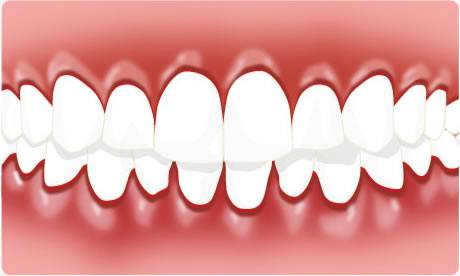 gingivitis-588917b9c6876c3c54cb5cc1000d5cb7.jpg gingivitis-588917b9c6876c3c54cb5cc1000d5cb7.jpg