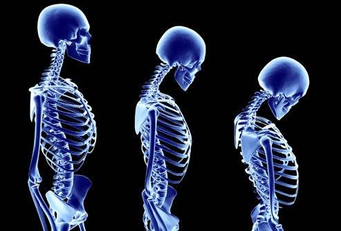 princrmphotoofstagesofosteoporosis-98540a95c6eac0792c5e8fec34b65901.jpg princrmphotoofstagesofosteoporosis-98540a95c6eac0792c5e8fec34b65901.jpg