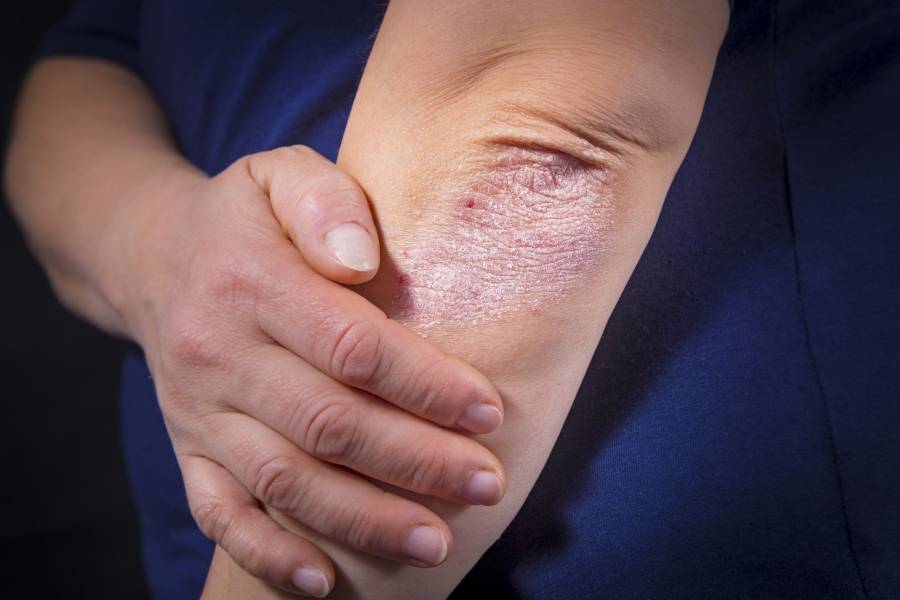 Psoriasis pustular de palmas y plantas