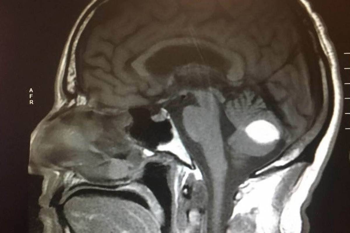 ¿desaparecen los dolores de cabeza por tumor cerebral?