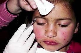 botox infantil