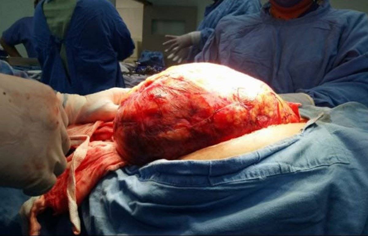 Tumor