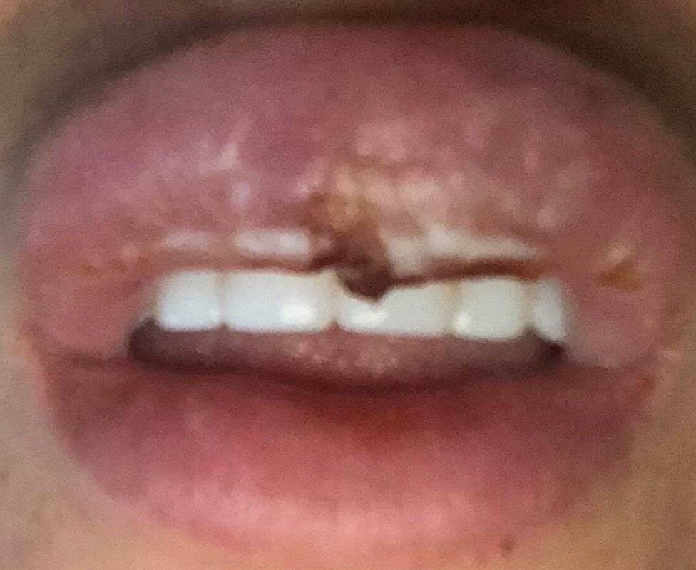 104604004lipfiller3-a029f11fc1564a23bbc373e6be113928.jpg