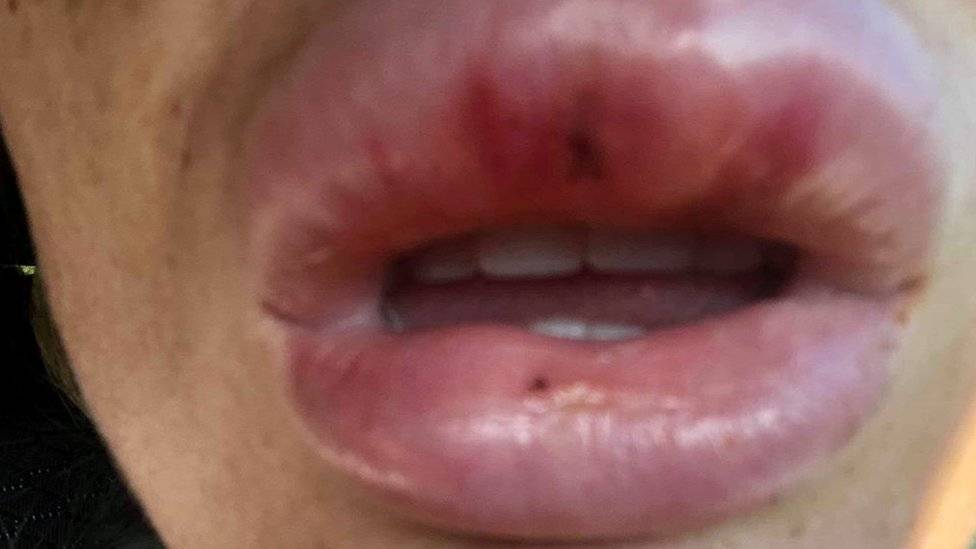 104626554lipfiller2-df82fabc2fa030f69f883be717e1246f.jpg