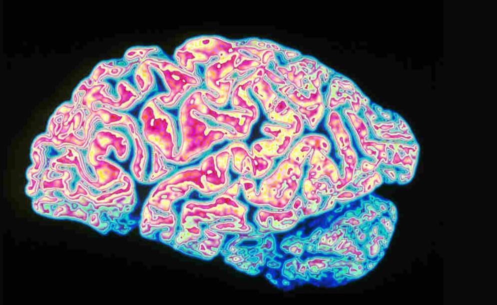 Alzheimer 