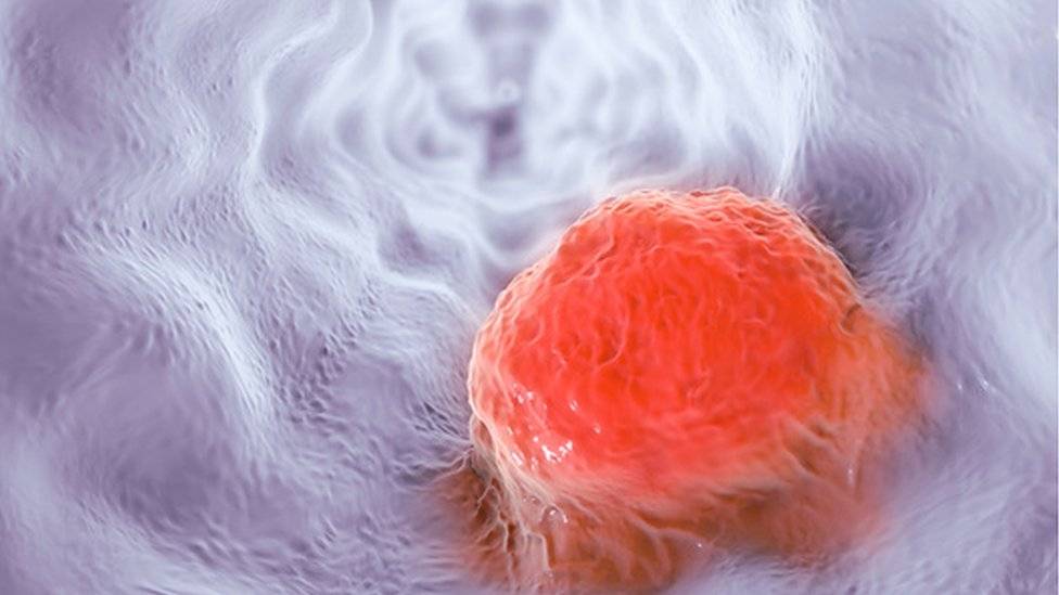 105050904f0187475oesophagealcancerillustrationspl-8fa168b9daef07cd94c157281f2081c5.jpg