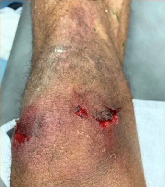 Rodilla Varane