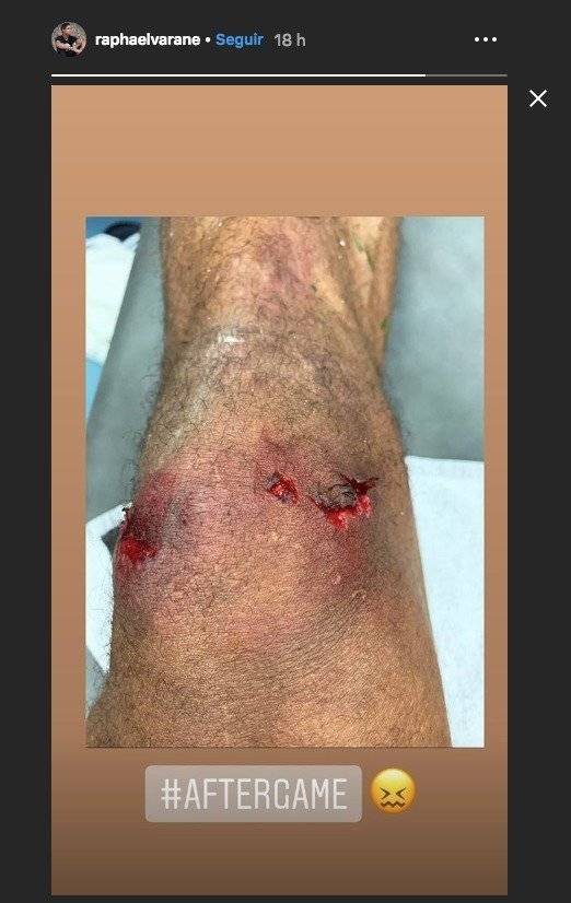 Rodilla de Rapahel Varane tras el Clásico