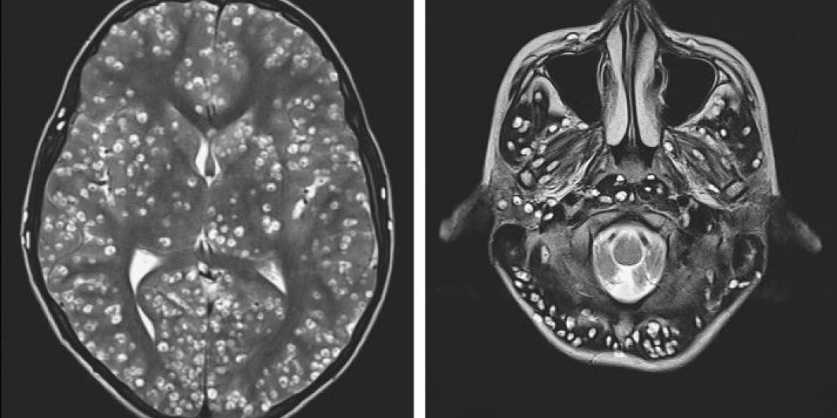 La impactante historia del paciente cuyo cerebro estaba lleno de parásitos