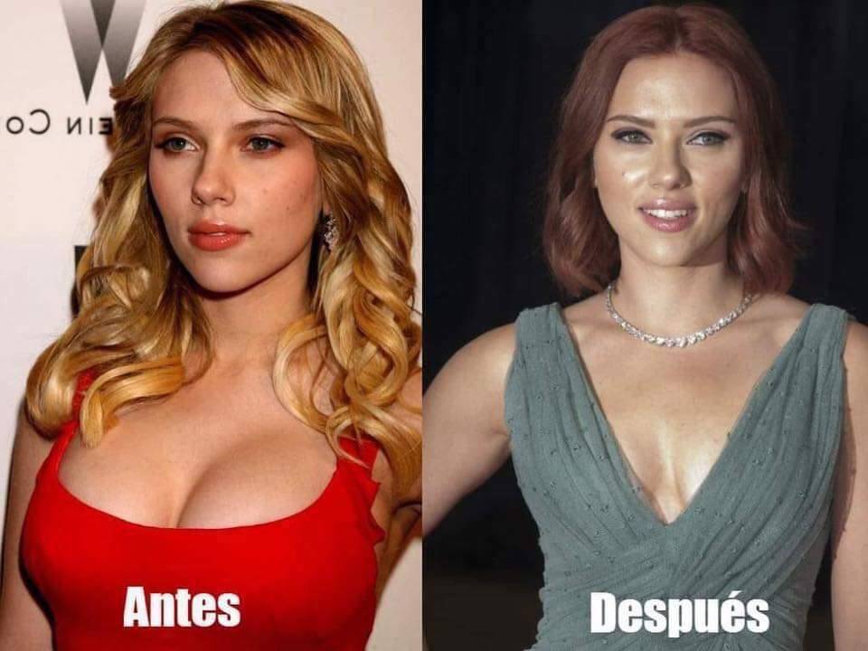 Scarlett Johansson: Este es el resultado de su reducción de senos Scarlett Johansson: Este es el resultado de su reducción de senos