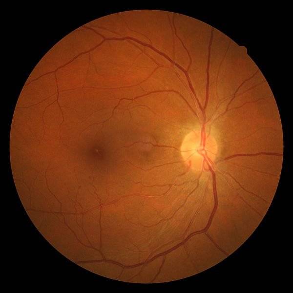 retinopatia