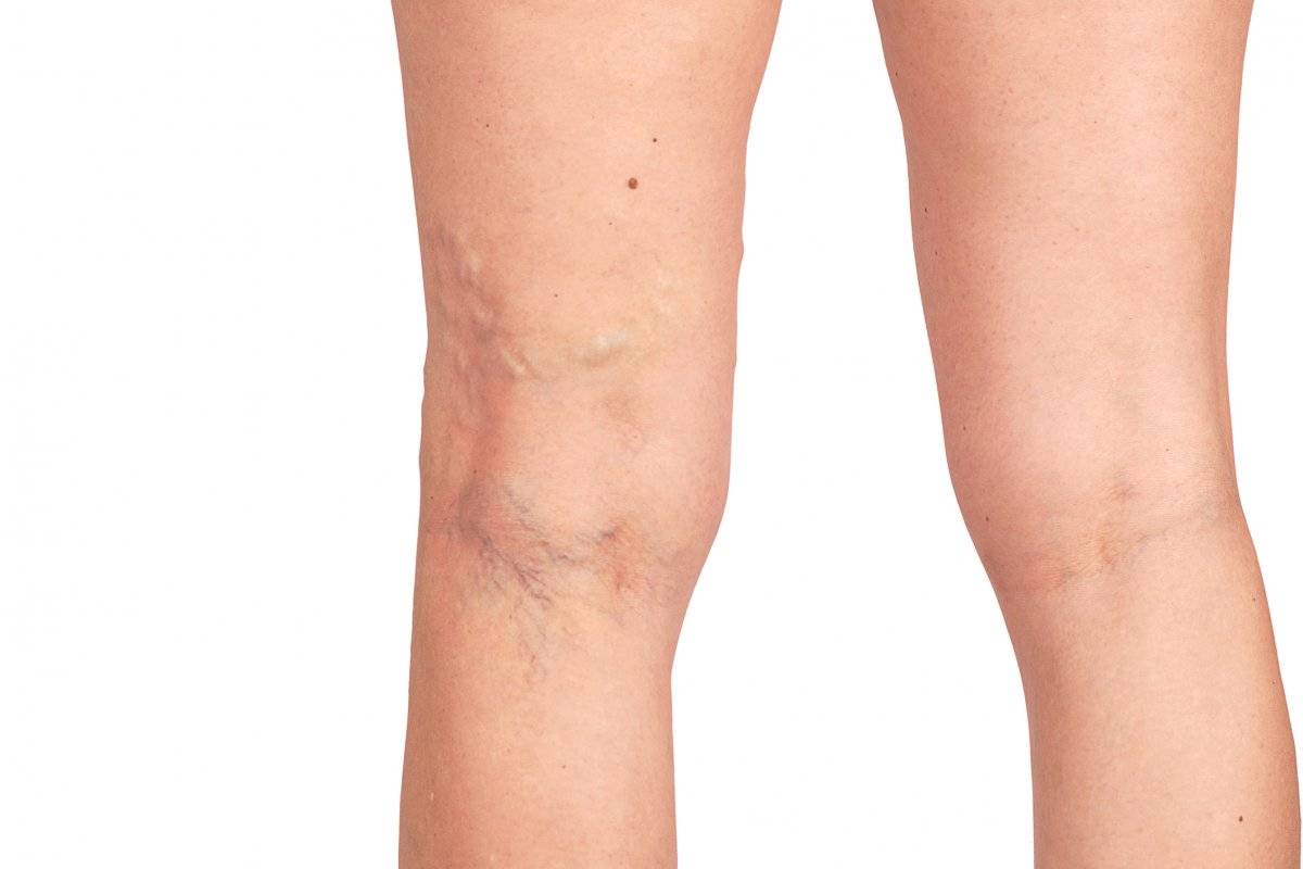 Piernas arterias