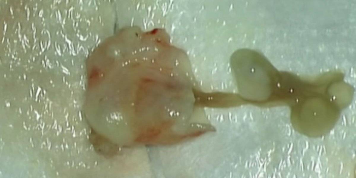 Encuentran enorme gusano viviendo al interior del cerebro de una mujer y sucede lo impensado: aseguró que era la mejor noticia y lo celebró con todo