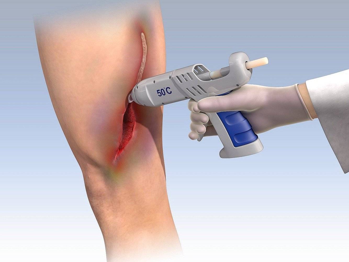 Médicos logran crear pistola de pegamento para reemplazar los puntos de sutura