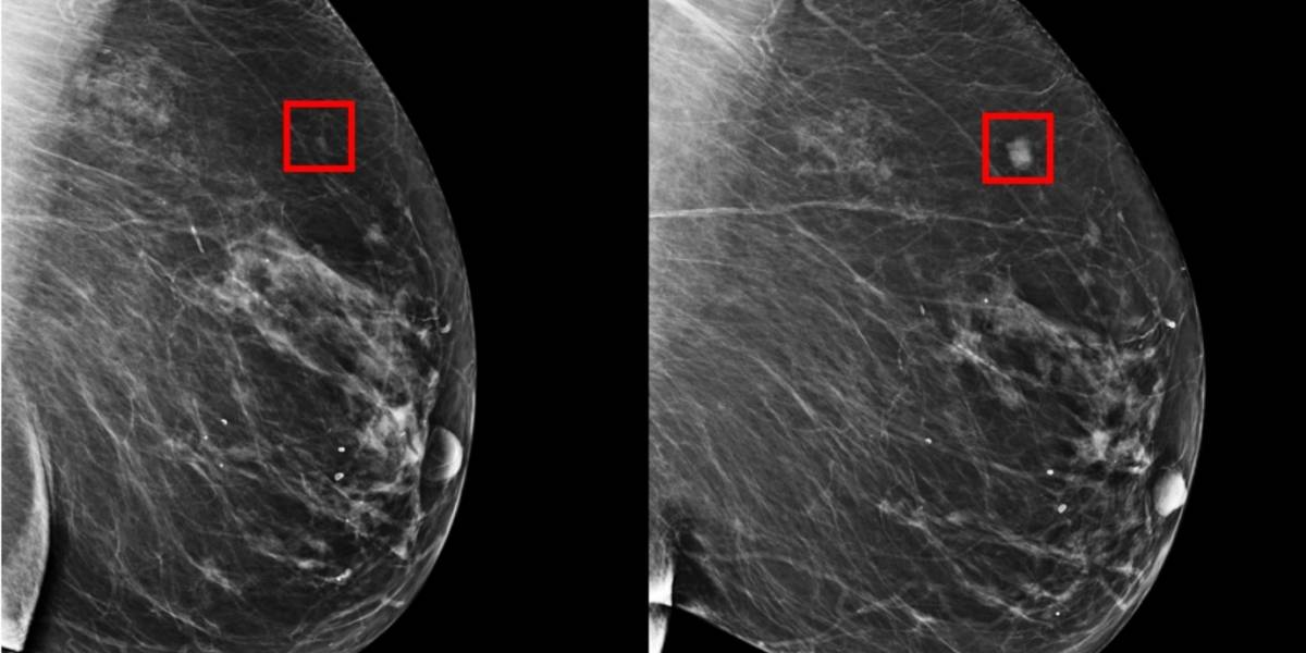 MIT crea IA que predice hasta con cinco años el cáncer de mamas
