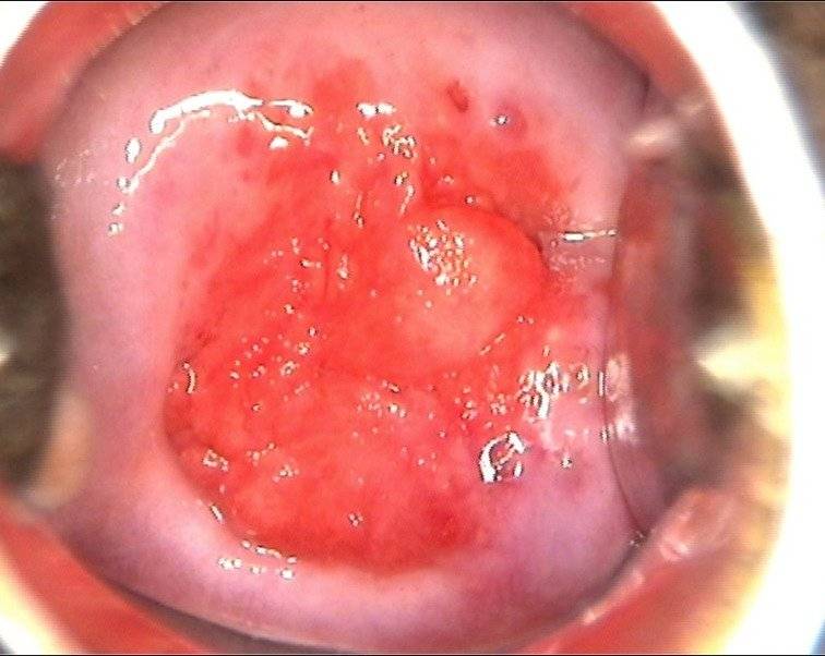 Cuello Uterino