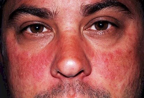 alergia