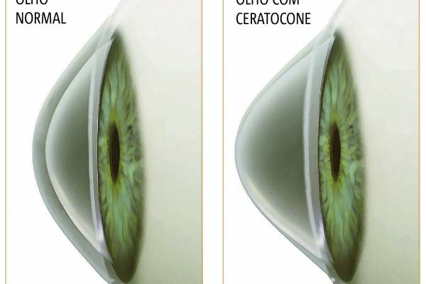 Ceratocone