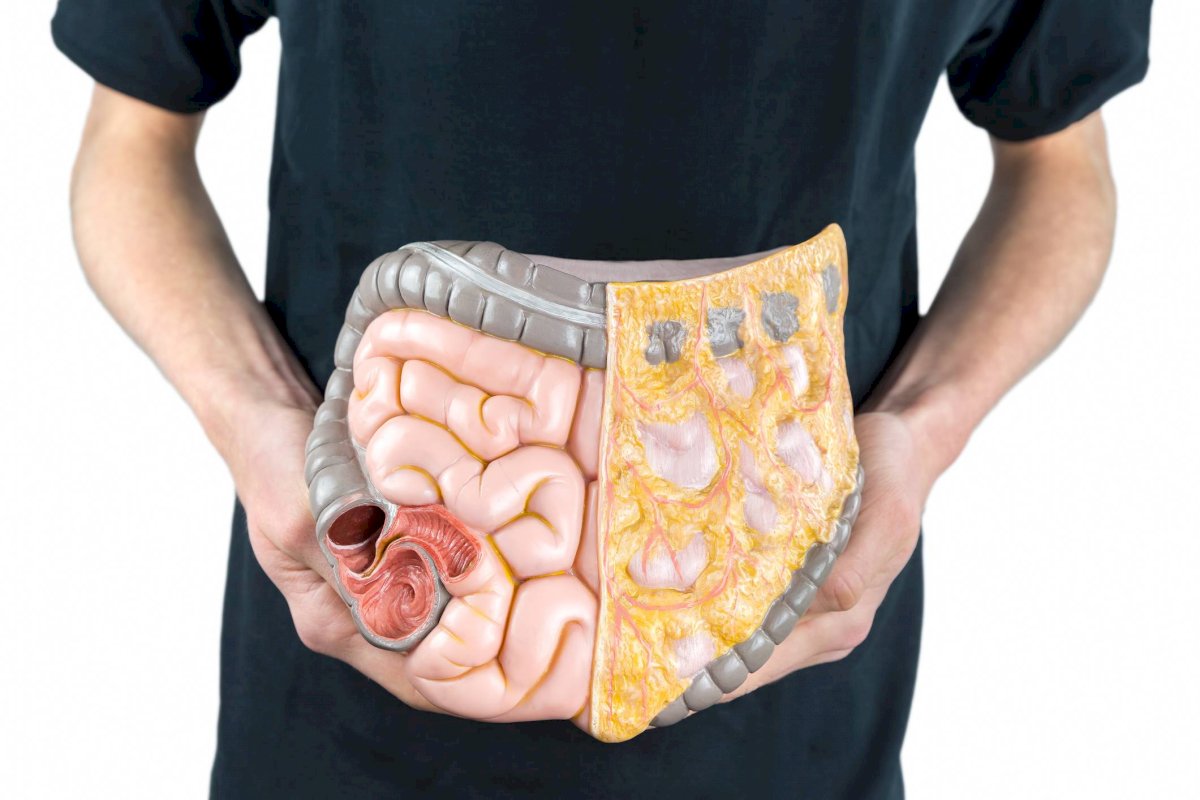 Cáncer de colon