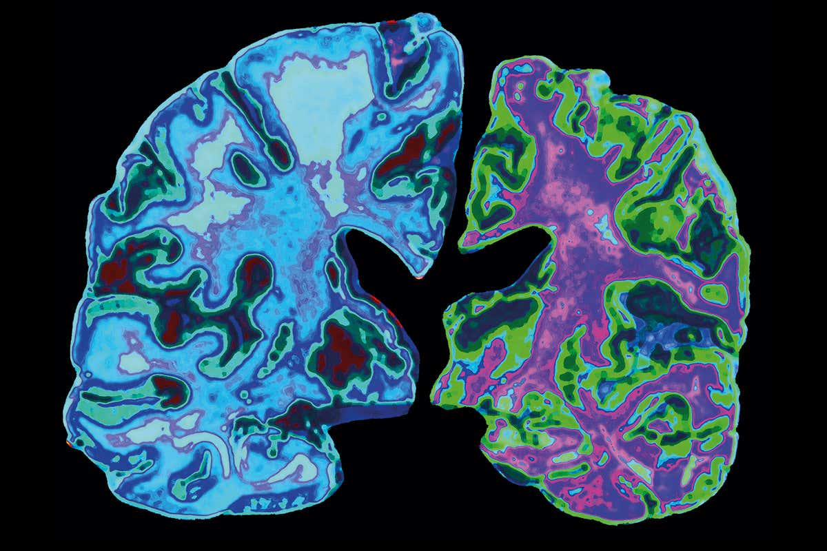 Vacuna Alzheimer Vacuna Alzheimer