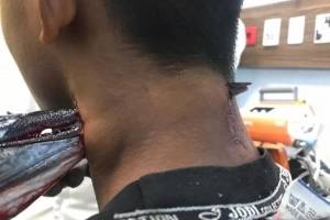 Garoto indonésio é perfurado no pescoço por peixe-agulha