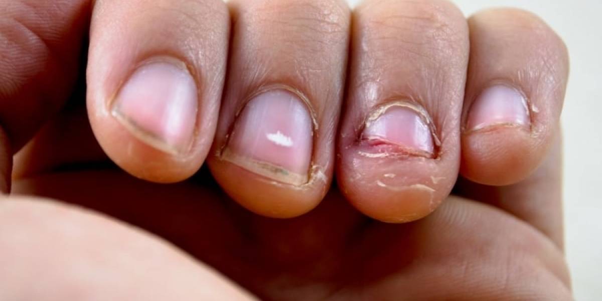Estuvo al borde la muerte: hombre sufre grave infección por comerse las uñas