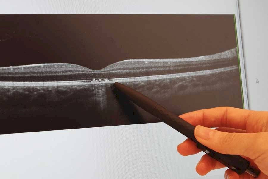 Niño sufre daños irreparables en los ojos al mirar fijamente un láser