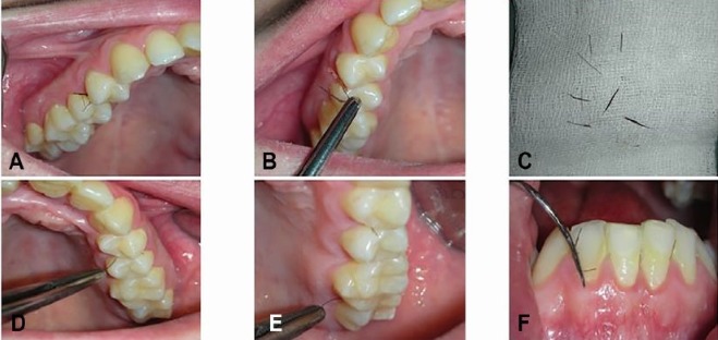 dientes pelos