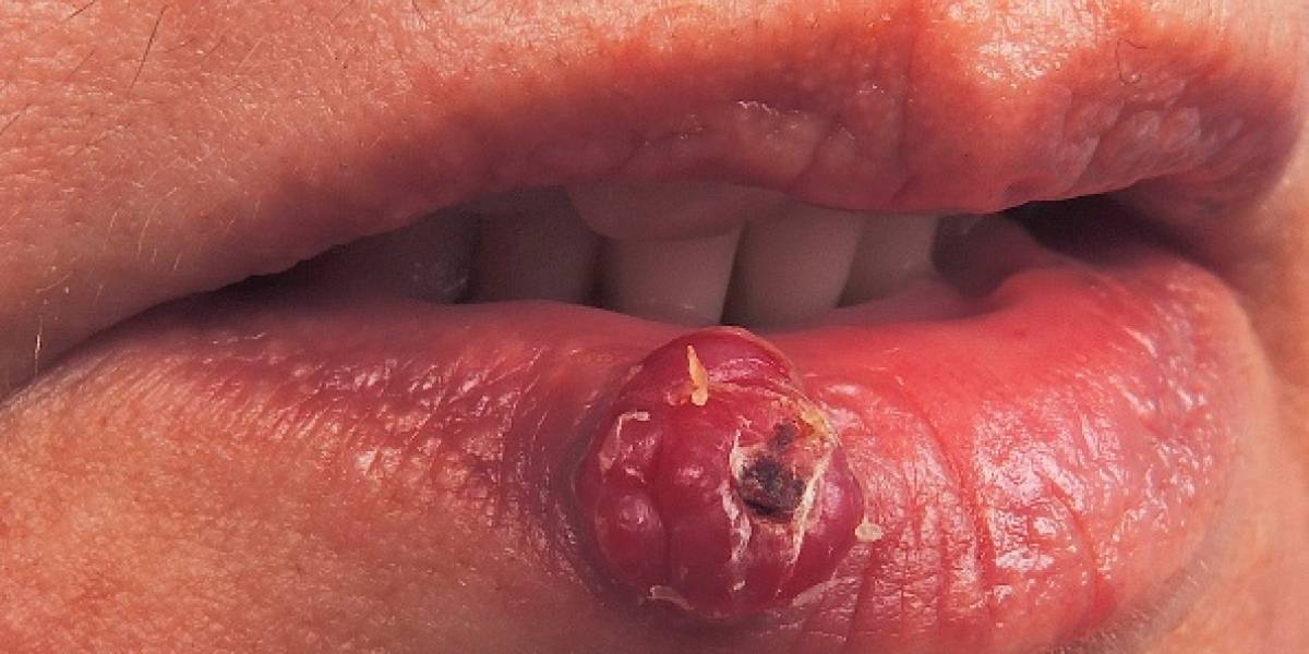 El insólito caso que desafía a la ciencia: mujer italiana sufre por el crecimiento de pelos en su boca