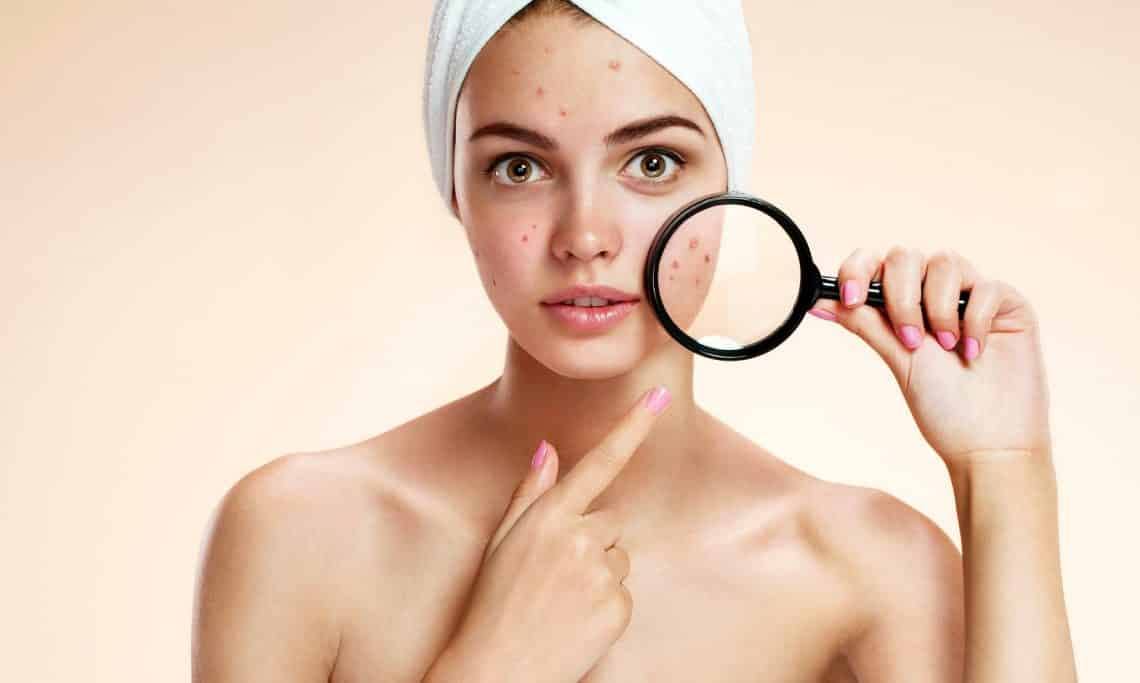 acne granos