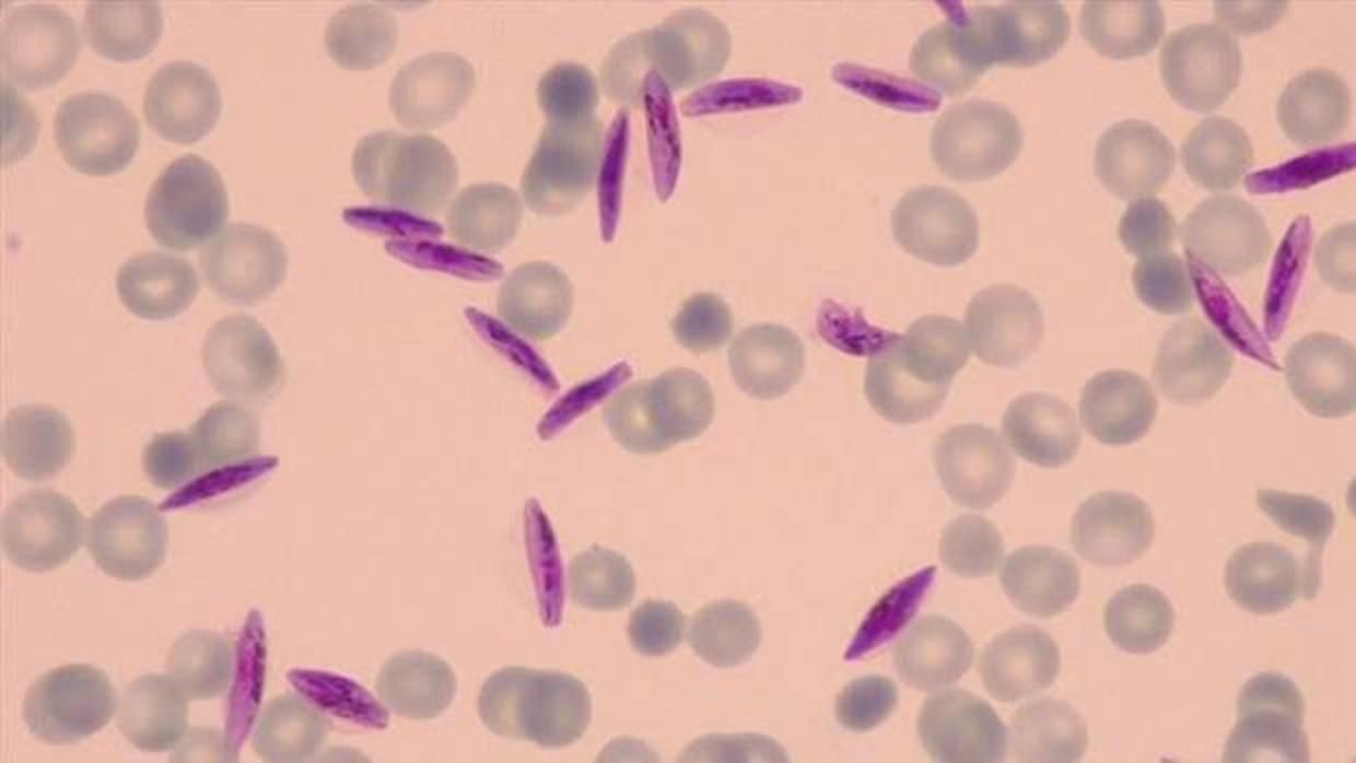 Malaria en Chile: Decretan riesgo sanitario en el norte del país por casos de la enfermedad Malaria en Chile: Decretan riesgo sanitario en el norte del país por casos de la enfermedad