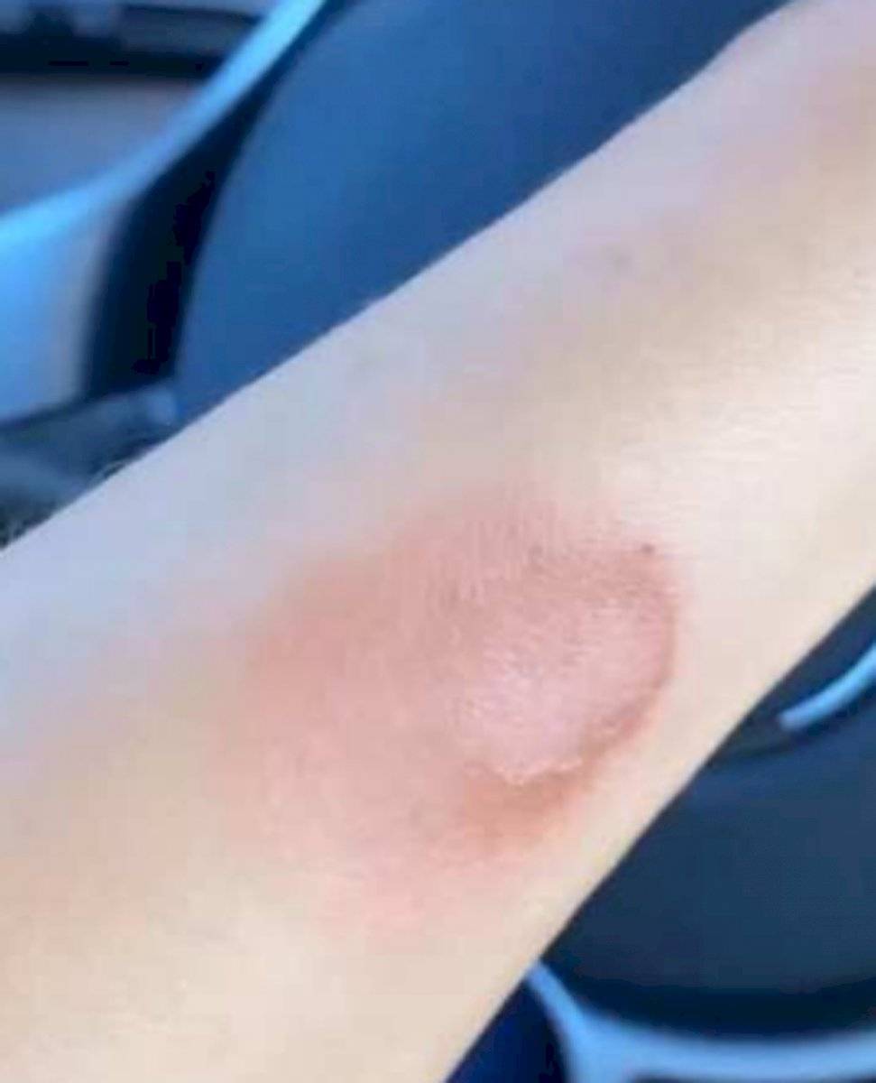 ¡Lo compartió en Instagram! Thalía sufrió una fuerte quemadura en su brazo (Video)