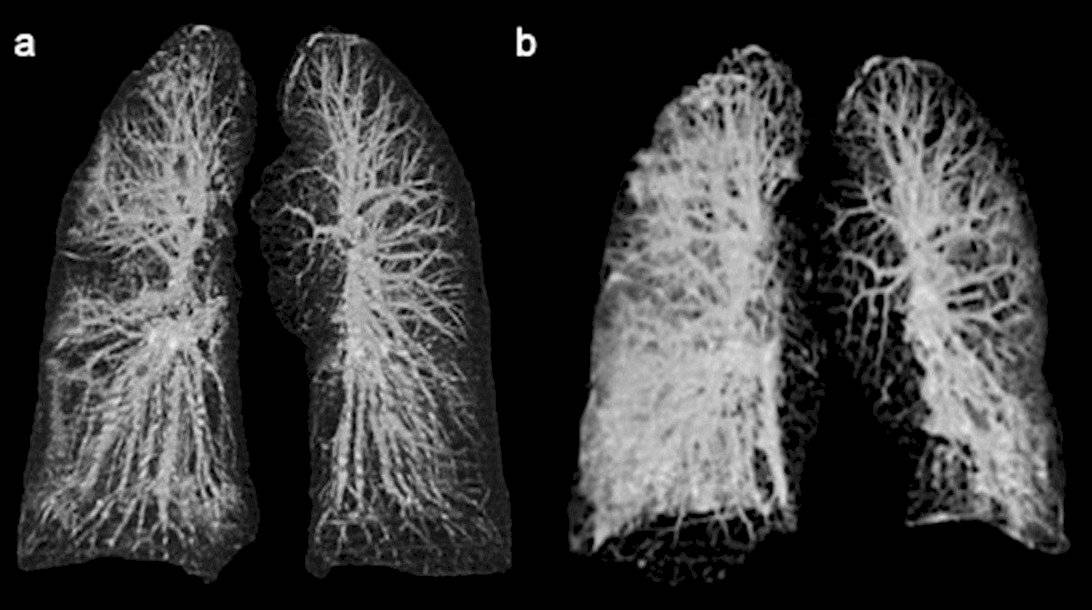 Radiografía pulmonar de pacientes de coronavirus en Italia