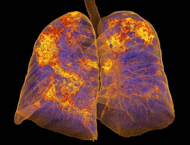 Pulmones afectados de coronavirus muestra neumonía