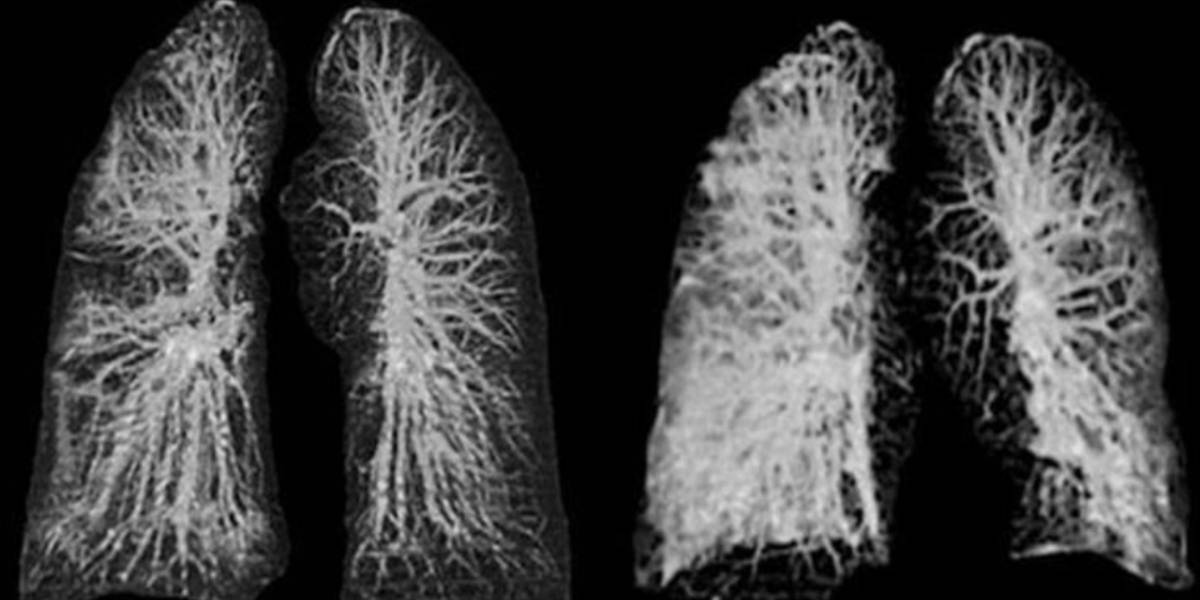 Coronavirus: así afecta los pulmones de los 4 tipos de pacientes