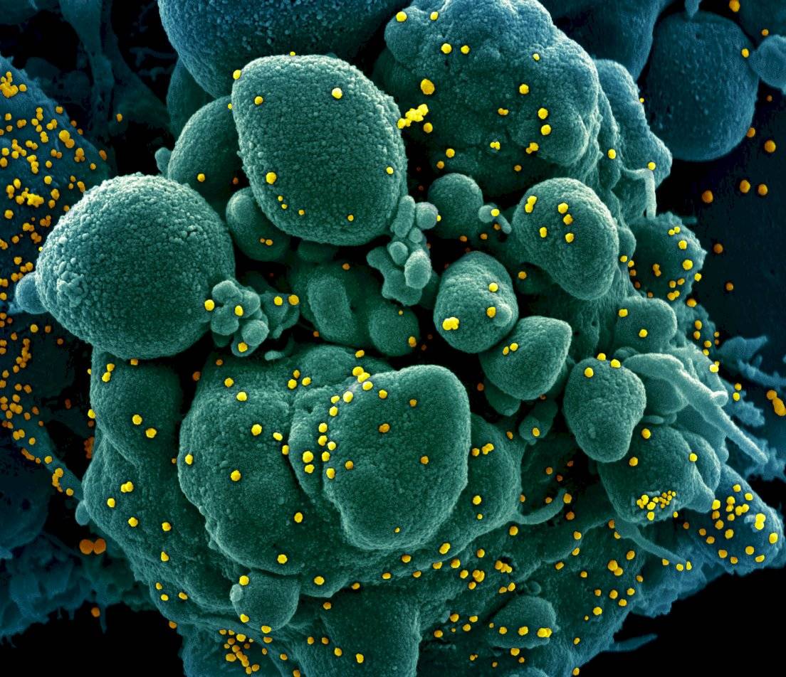 Una célula humana rodeada por SARS-CoV-2. Imagen coloreada.