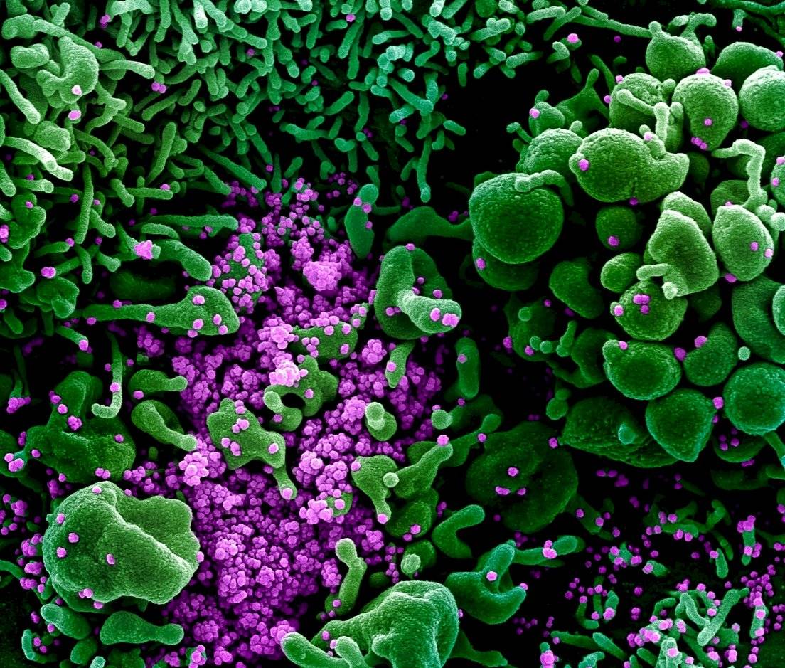 Una célula humana rodeada por SARS-CoV-2. Imagen coloreada.